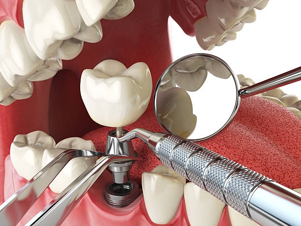 Best Emergency Wisdom Teeth Removal in Norridge, IL